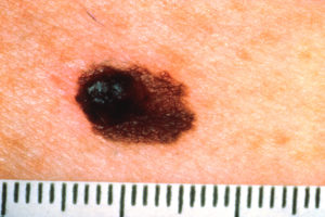 melanoma giovanile